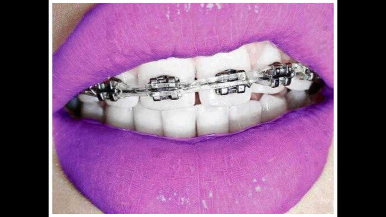 Moje iskustvo sa fiksnom protezom