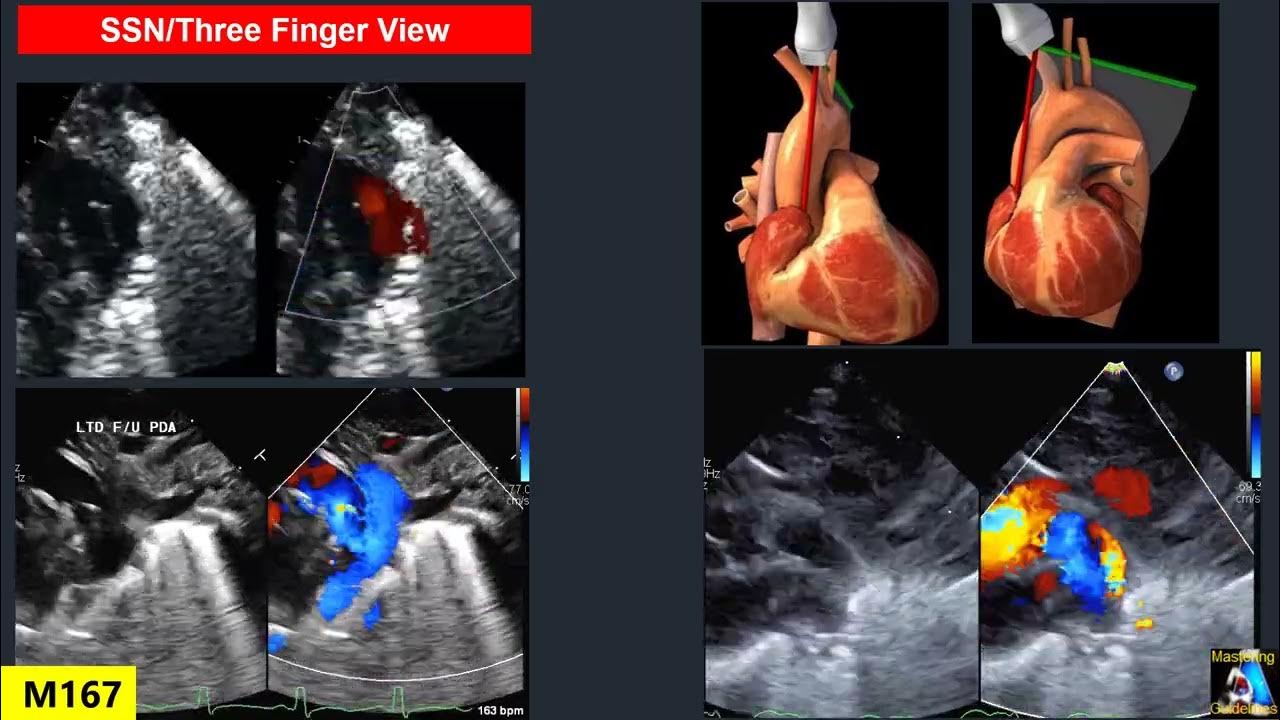Pediatric Echo Patent Ductus Arteriosus (PDA) supplement YouTube