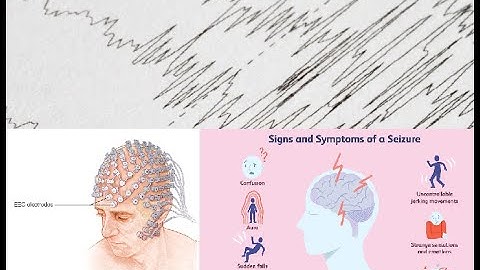 Epileptic Seizure Detection based on EEG and CNN