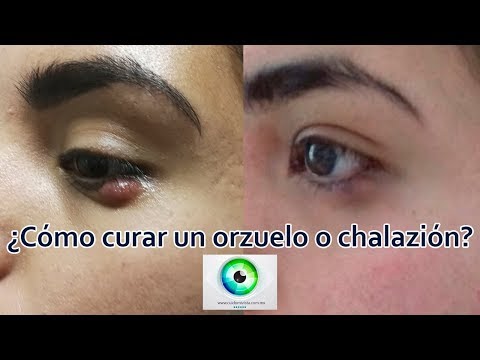 Vídeo: Holazion: Tratamiento Del Chalazión Con Remedios Y Métodos Populares