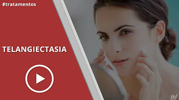 O que significa presença de telangiectasias?