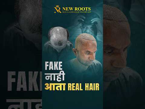 The New Roots Hair Transplant Experience in Aurangabad: A Patient's Story #hairtransplant #shorts