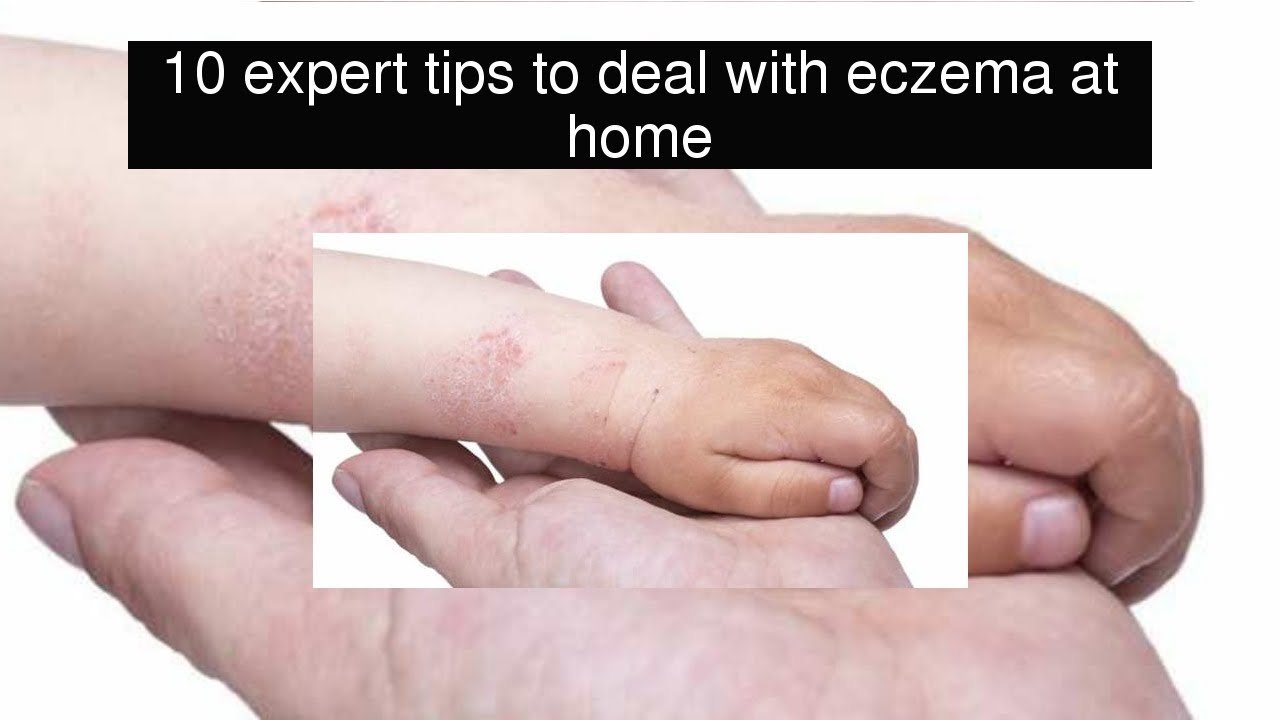 10 expert tips to deal with eczema at home 