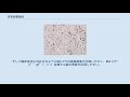 多系統萎縮症