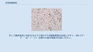 多系統萎縮症