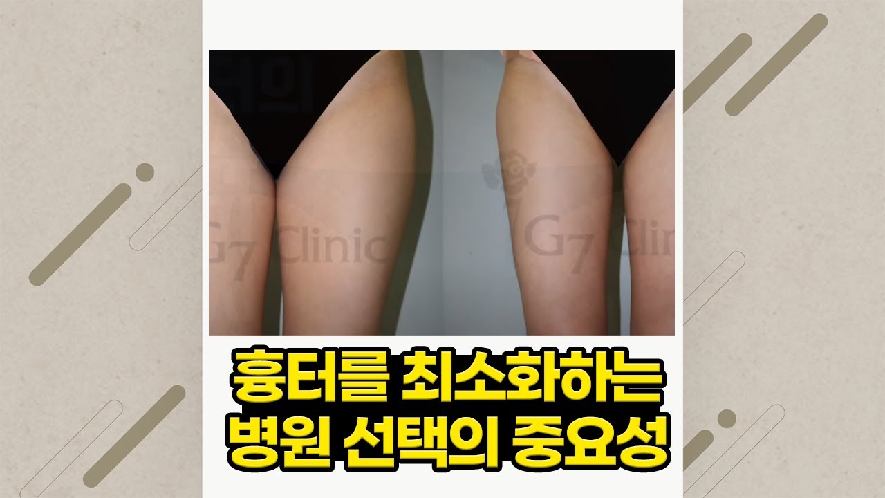 지방흡입 흉터 | 영상으로 보는 블로그 | 닥터 조의 지방흡입에 대한 생각들