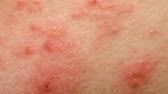 Acne, Blackheads, Treatments, And Prevention - YouTube