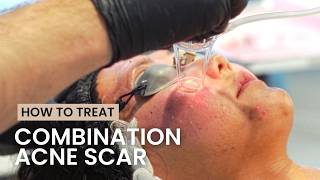 My Favorite Acne Scar Treatment: TCA Cross, Subcision, CO2 Laser, Bellafill