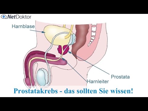Video: Prostatakrebs Und Rückenschmerzen: Ist Es Ein Symptom?