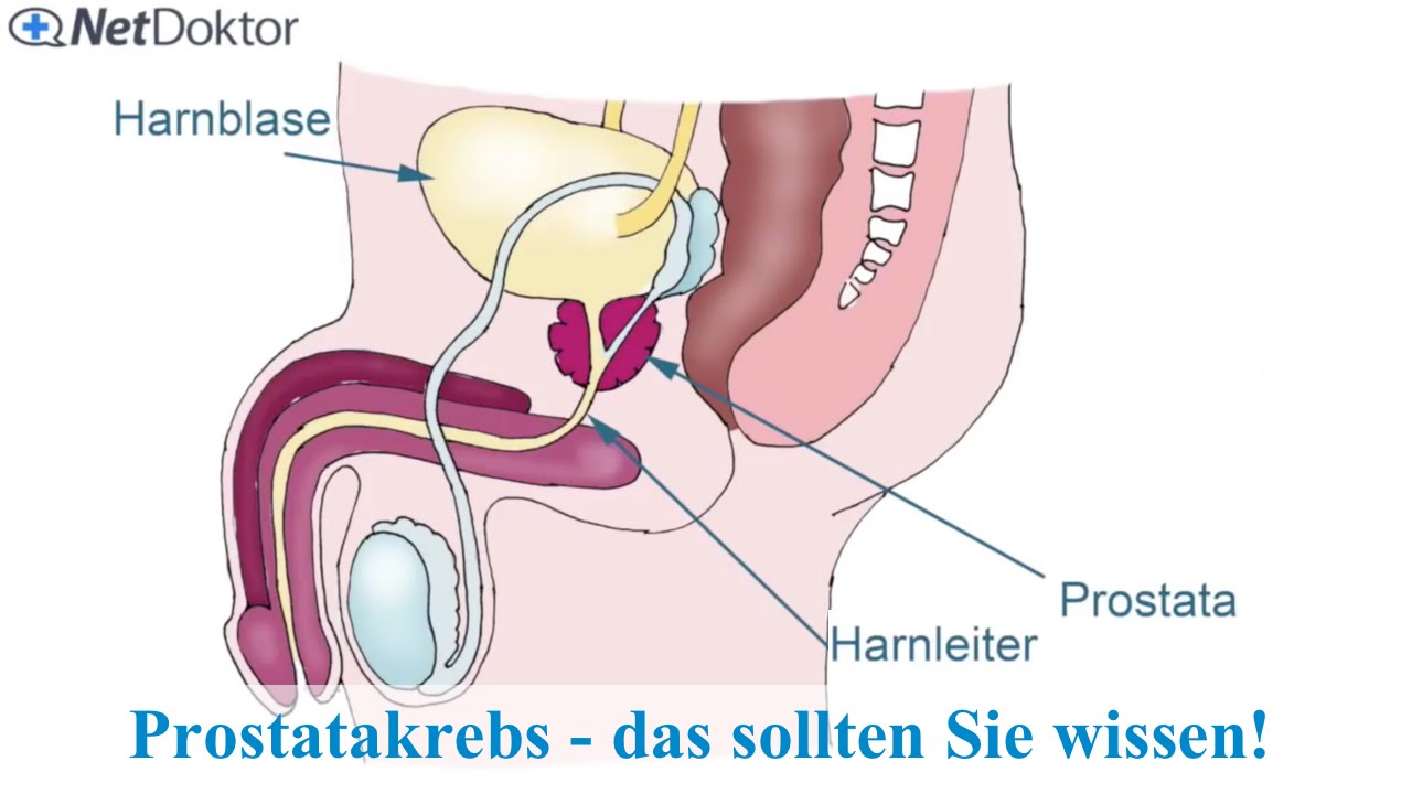 prostatakrebs netdoktor)