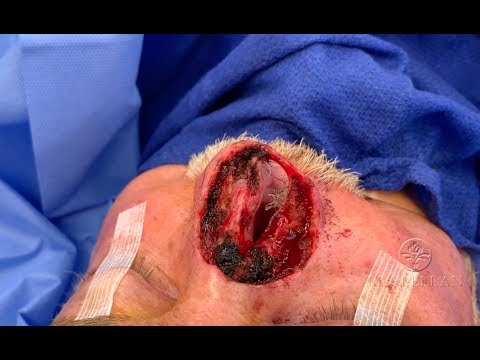 Complex Nose Reconstruction with Cartilage and Forehead Flap