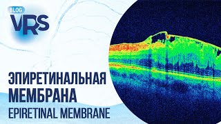 Эпиретинальная мембрана | Epiretinal membrane