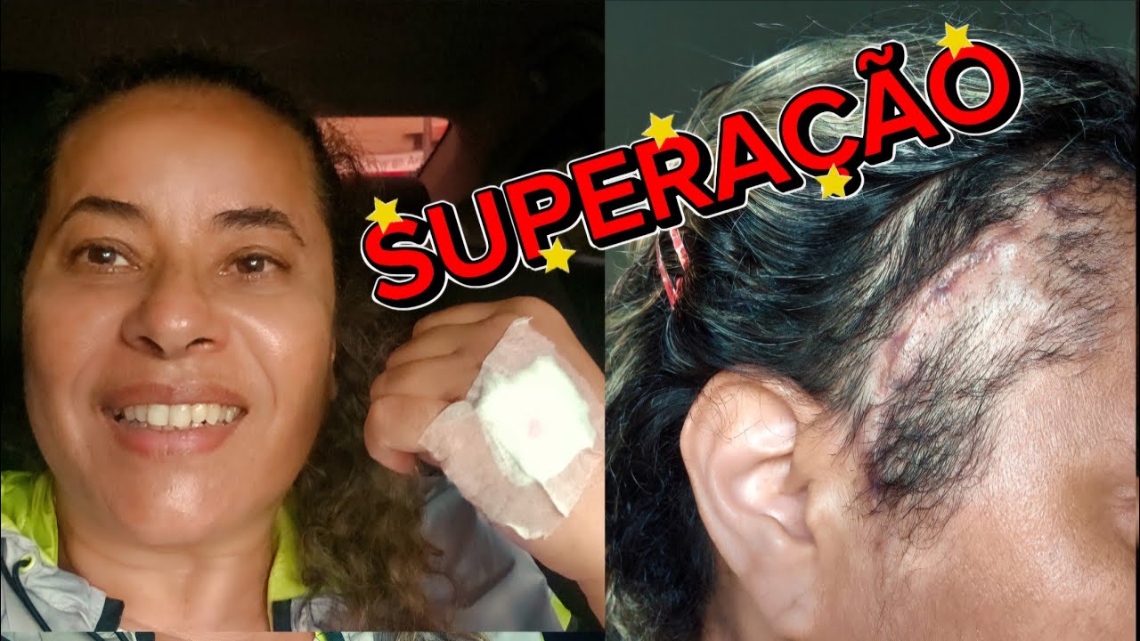 "SUPERANDO  O  ANEURISMA: MINHA  HISTÓRIA DE  RECUPERAÇÃO "