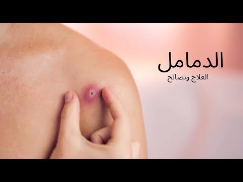 الدمامل موجلود الاسباب والعلاج