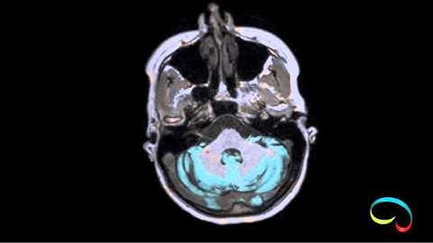 Icometrix segmentation