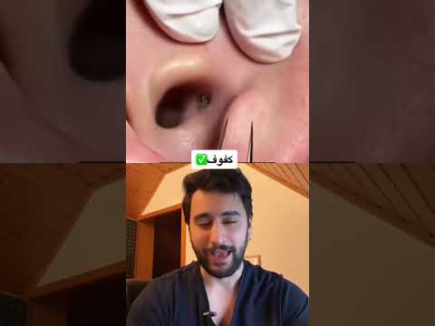 فيديو: هل يجب إزالة الرؤوس السوداء؟