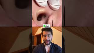 ازالة الرؤوس السوداء كطبيب جلدية ‍️ #دكتور_يوسف