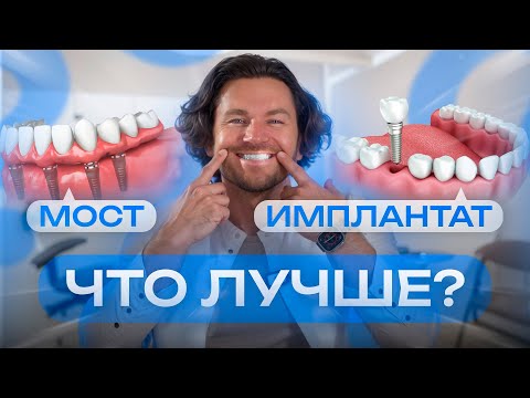 Зубной мост или имплантация зубов? Что выбрать? / Плюсы и минусы