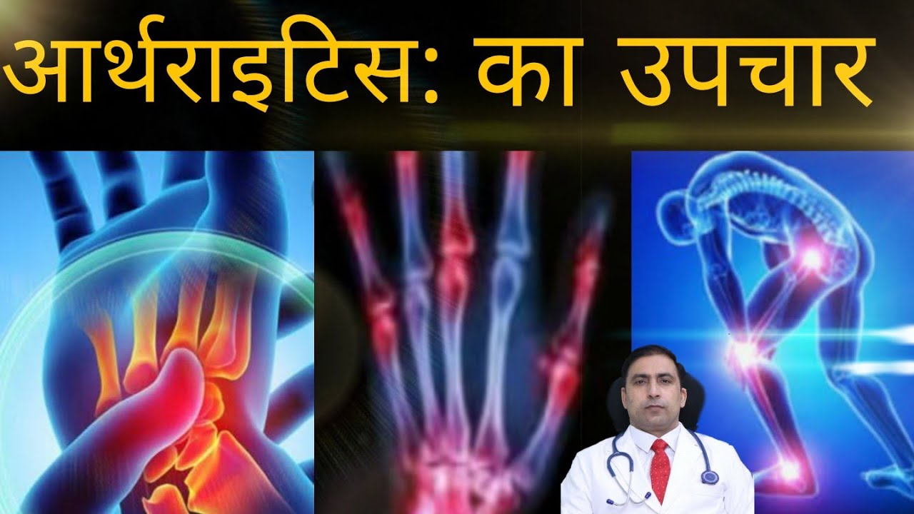 आर्थराइटिस का उपचार? Arthritis ke Lakshan Aur Ilaj Arthritis