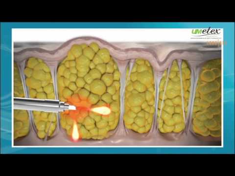 Cellulaze  лазерная липосакция