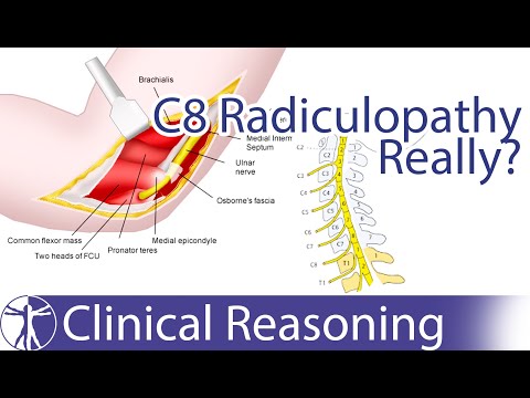 Ulnar Nerve Entrapment mimicking C8 Radiculopathy