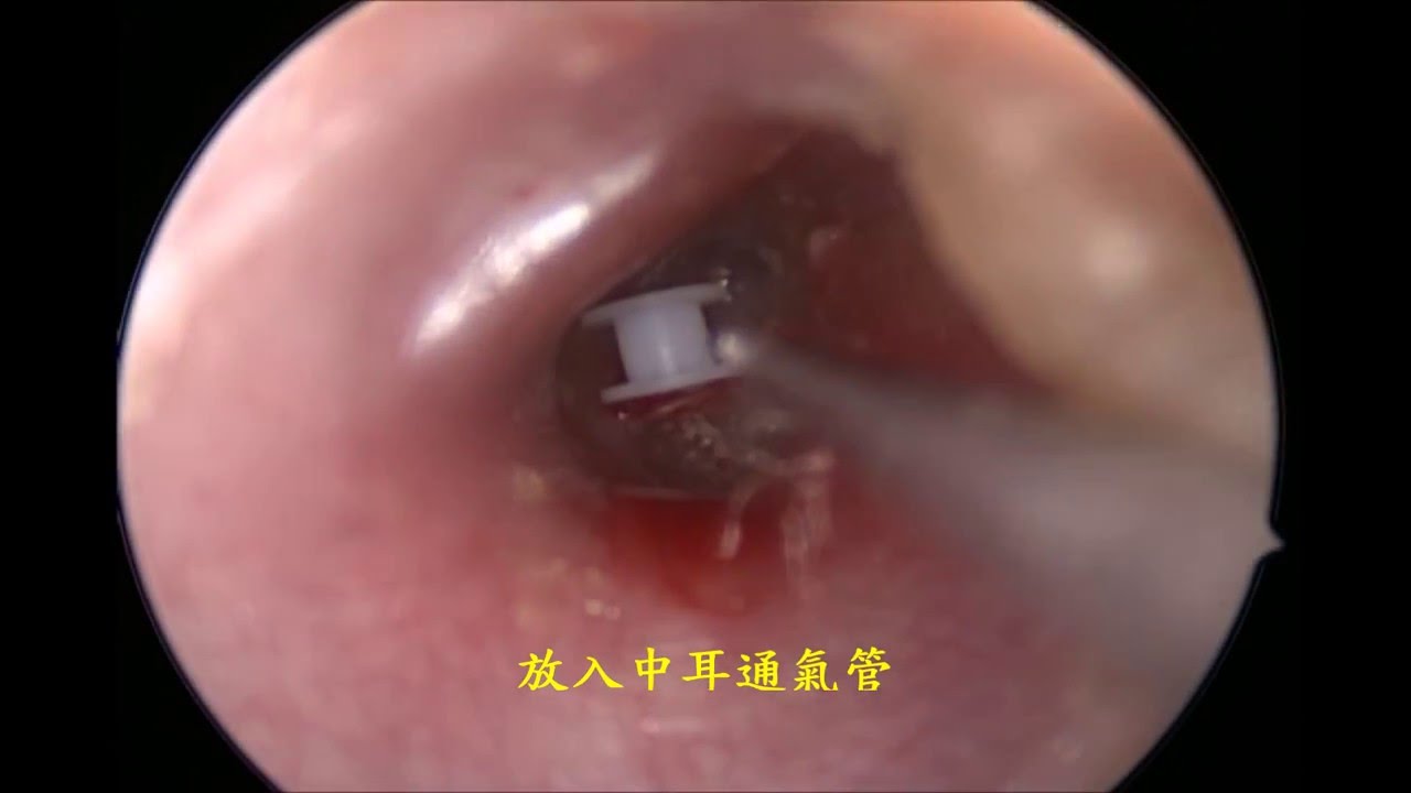 中耳积水常见手术 放置中耳通气管 简体版