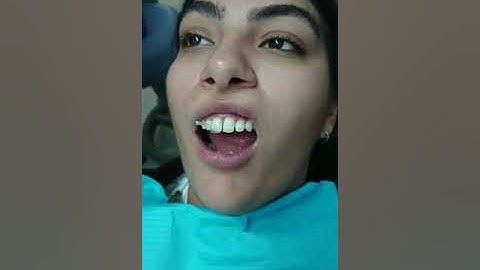 IVENEER MATRIX SYSTEM - Creating a tooth in 60 sec