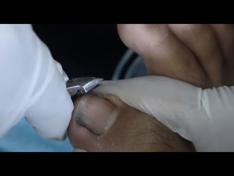 Ep_2783 Foot nails skin removal ðŸ‘£ à¹‚à¸®à¹‰..à¸™à¹‰à¸­à¸‡à¸•à¹‰à¸­à¸‡à¸”à¸¹à¹€à¸­à¸‡ ðŸ˜· (This clip is from Thailand)