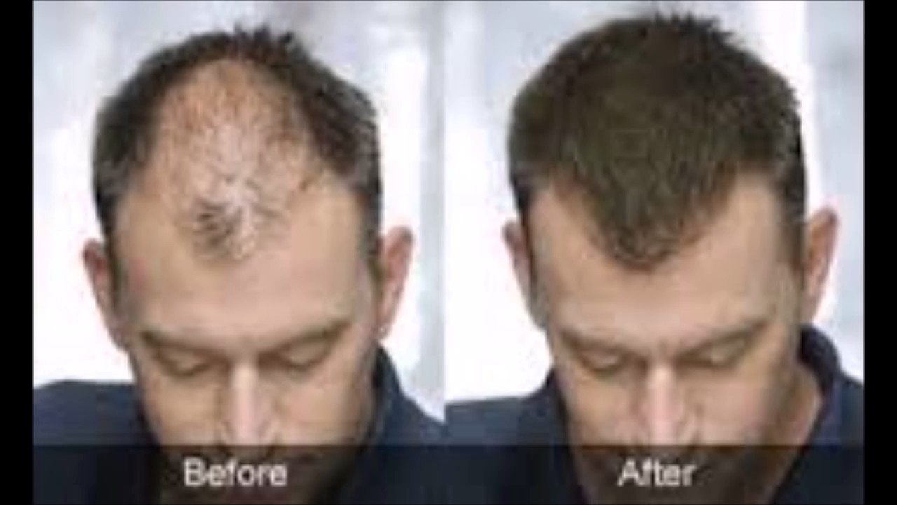 Seborrheic Dermatitis Hair Loss Before And After Seborrheic