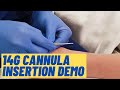 Large (14G) cannula insertion technique - Live Demo