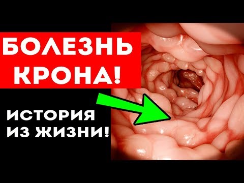 Вот как ПИТАНИЕ ПОБЕДИЛО серьезный ДИАГНОЗ! Воспаление кишечника ВЗК (болезнь Крона)