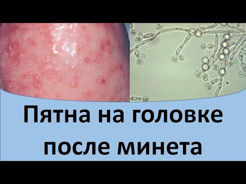 Пятна на головке после минета