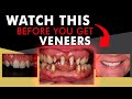 BEFORE Getting Veneers - Essential facts you need to know