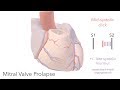 Mitral Valve Prolapse - sound & animation