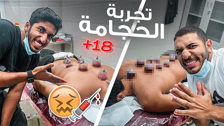 تجربتنا للحجامة 💉 || اول مرة نسويها 😣 | HIJAMA EXPERIENCE