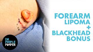 Dr. Lee's Lipoma Extraction Comes With A Blackhead Bonus | Dr. Pimple Popper