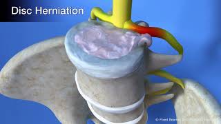 How does Spinal Decompression work?  Health First Group