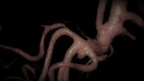 TINY RIGHT MCA TRIFURCATION ANEURYSM COILING