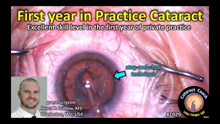CataractCoach 1029: first year practice stop-and-chop cataract surgery