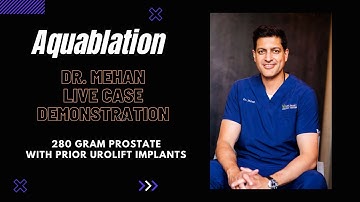 Best procedure for an enlarged prostate - Aquablation. Live recording, 280 grams with prior Urolift