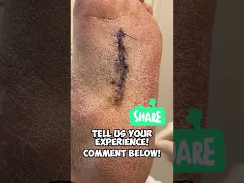 Video: Gjør det vondt å fjerne sutur?