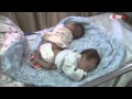 3D Printing Technology Aids Separation of Conjoined Twins in Shanghai, China