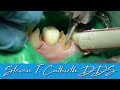 Prepping Decayed Mandibular Cuspid and Bi-Cuspid for Crowns - with Steven T. Cutbirth, DDS