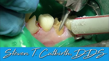 Prepping Decayed Mandibular Cuspid and Bi-Cuspid for Crowns - with Steven T. Cutbirth, DDS