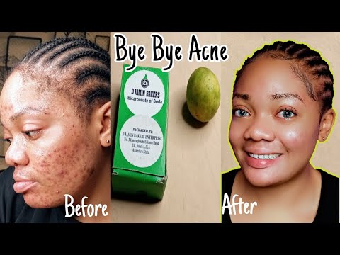 USE BAKING SODA AND LIME TO GET A GLASS SKIN | TESTED AND APPROVED | ACNE&rsquo;S TERROR