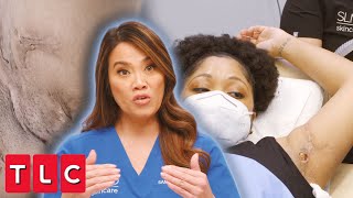 Dr. Lee Treats Extreme Scarring In Patient's Armpits | Dr. Pimple Popper