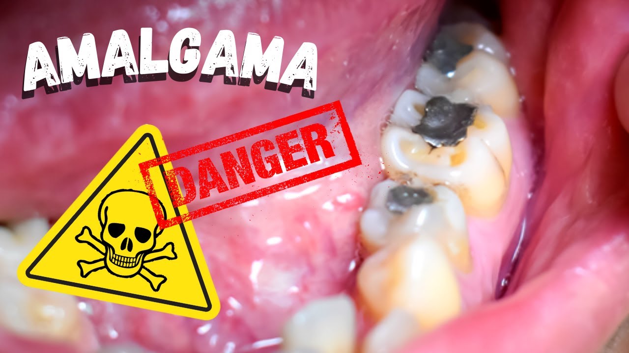 Amalgama dental es Toxica/Si tienes una debes ver este video YouTube