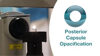 Yag Laser Capsulotomy for Posterior Capsule Opacification