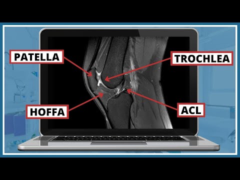 Video: Hoe om normale en abnormale lumbale MRI -resultate te lees en te herken