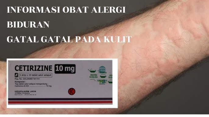 Informasi Obat Gatal Kulit Alergi Cetirizine Hcl Obat Untuk Penyakit Kulit Youtube